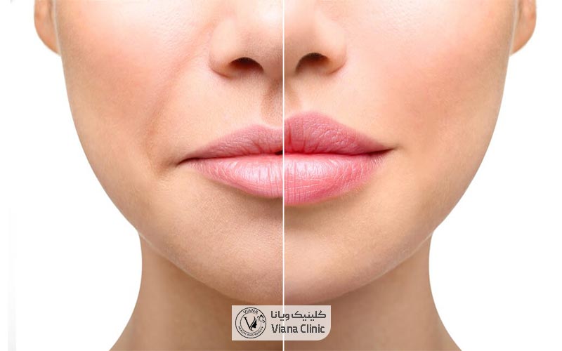 عکس قبل و بعد واقعی نمونه تزریق فیلر و ژل لب