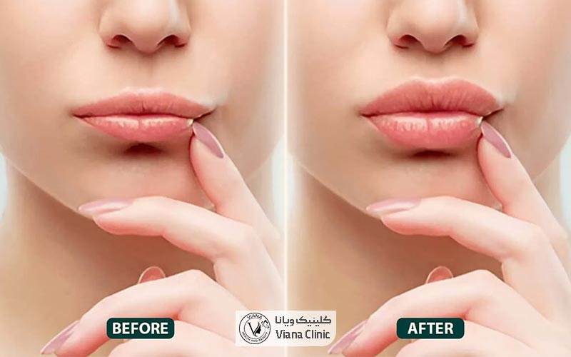 عکس قبل و بعد از تزریق فیلر و ژل لب و نکات مراقبتی بعد از آن