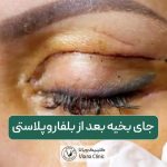 جای بخیه بعد از بلفاروپلاستی و عمل جراحی پلک