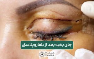 جای بخیه بعد از بلفاروپلاستی و عمل جراحی پلک