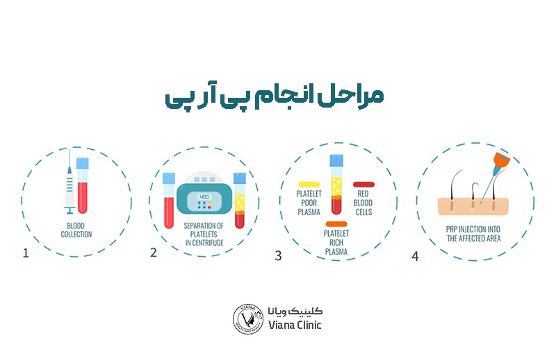 مراحل پی آر پی و نحوه انجام آن