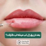آیا بعد تزریق ژل لب میشه لب گرفت؟ بوسیدن و رابطه دهانی و سکس بعد از تزریق فیلر لب