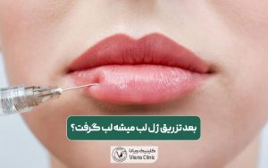 آیا بعد تزریق ژل لب میشه لب گرفت؟ بوسیدن و رابطه دهانی و سکس بعد از تزریق فیلر لب